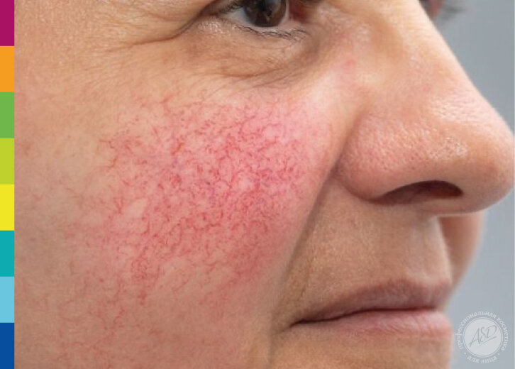 Купероз (телеангиоэктазии) на лице - расширенная сосудистая сеть, ключевое значение в развития купероза имеет - несостоятельность коллагеновых и эластических волокон, что приводит к пассивному расширению сосудов.