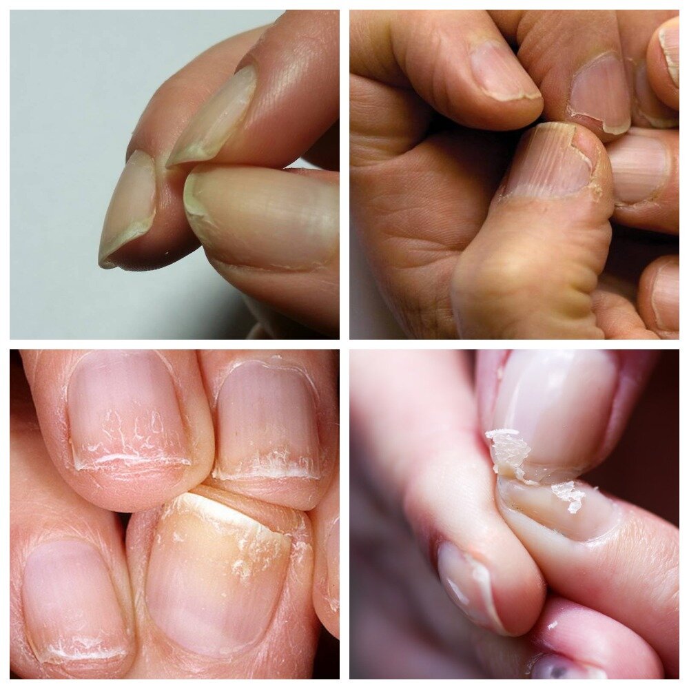 Ломкие ногти