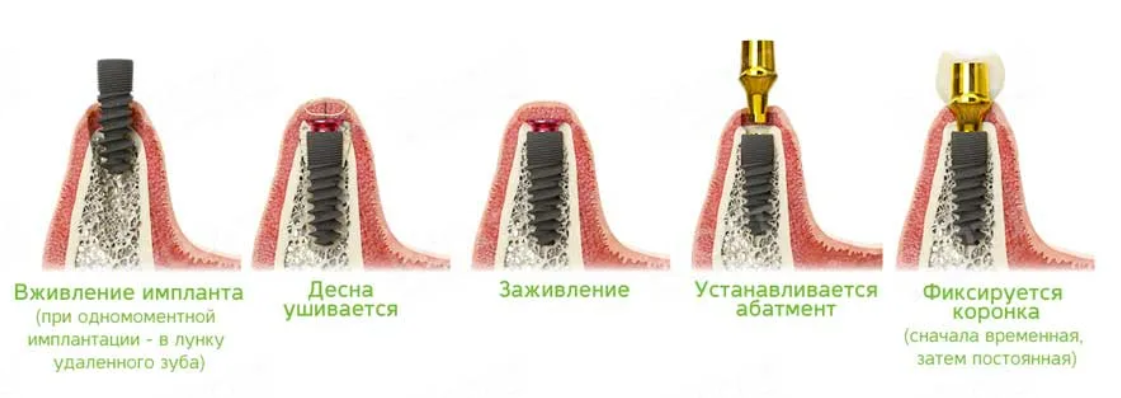 Схема имплантации зубов