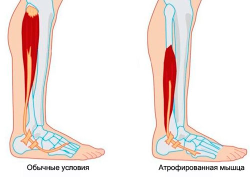 Массаж при артрофии мышц