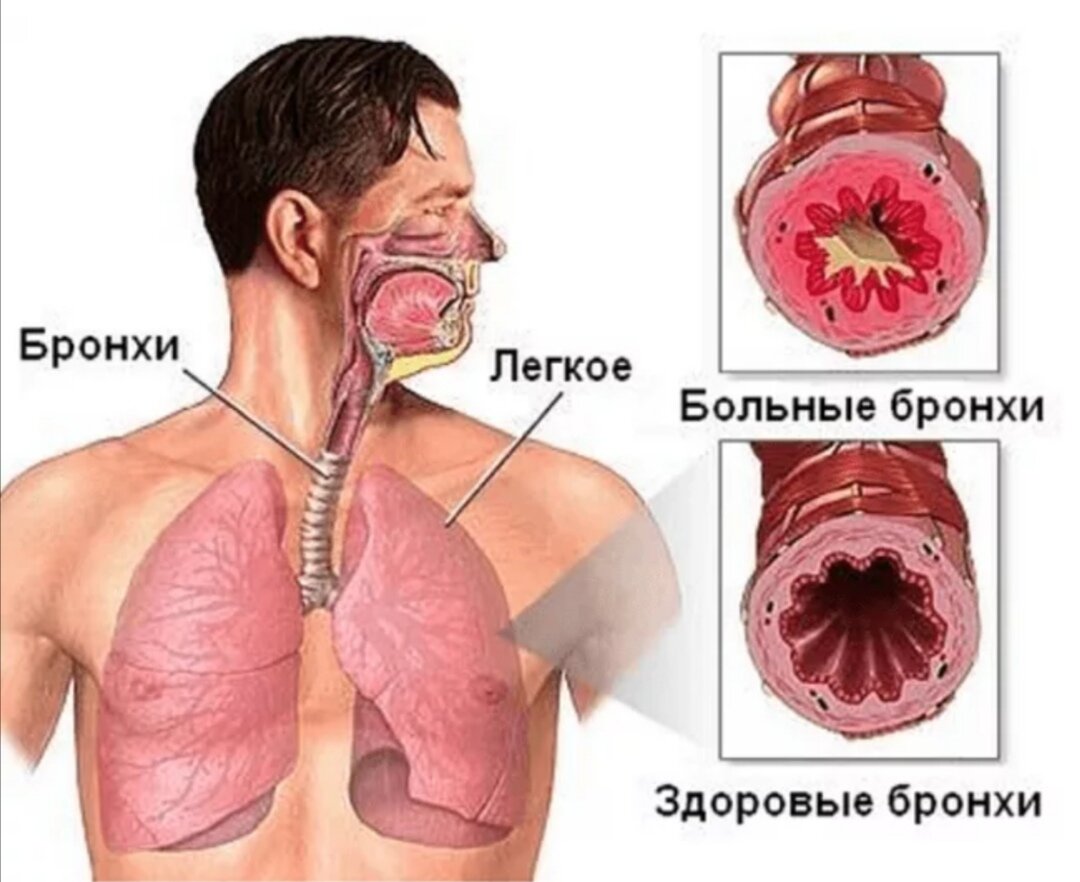 Хронический бронхит и астма