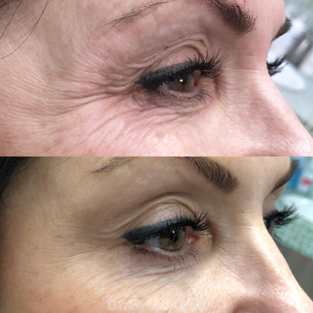 Коррекция морщин около глаз при помощи ботулотоксина. Как видно на фото, ботокс разгладит морщинки, но не уберет излишки кожи, не улучшит ее качество. Фото с сайта хирурга Д.Р.Гришкяна, имеются противопоказания, требуется консультация специалиста. 