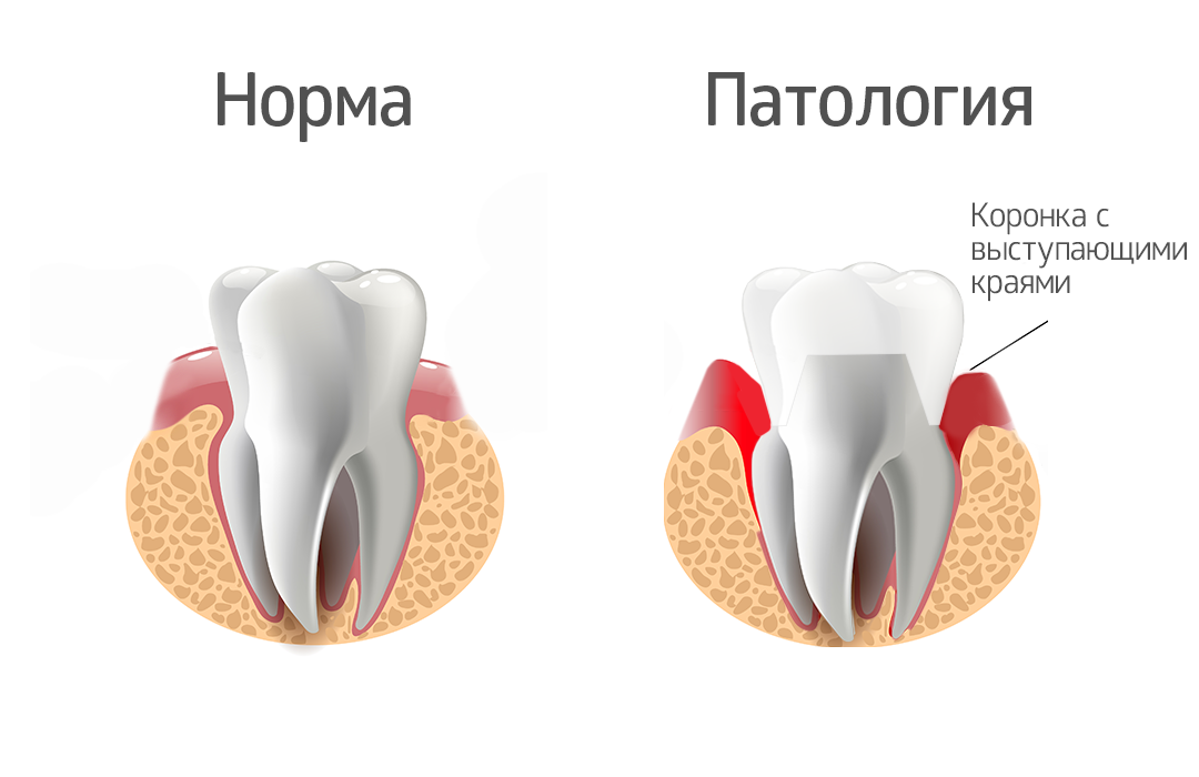 Лечение десневых карманов