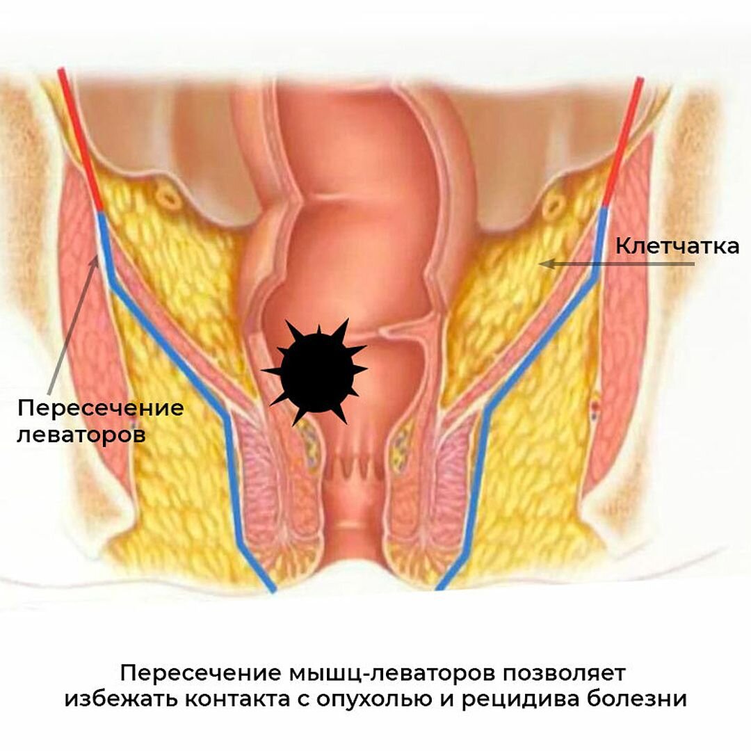 Рак ануса и анального канала