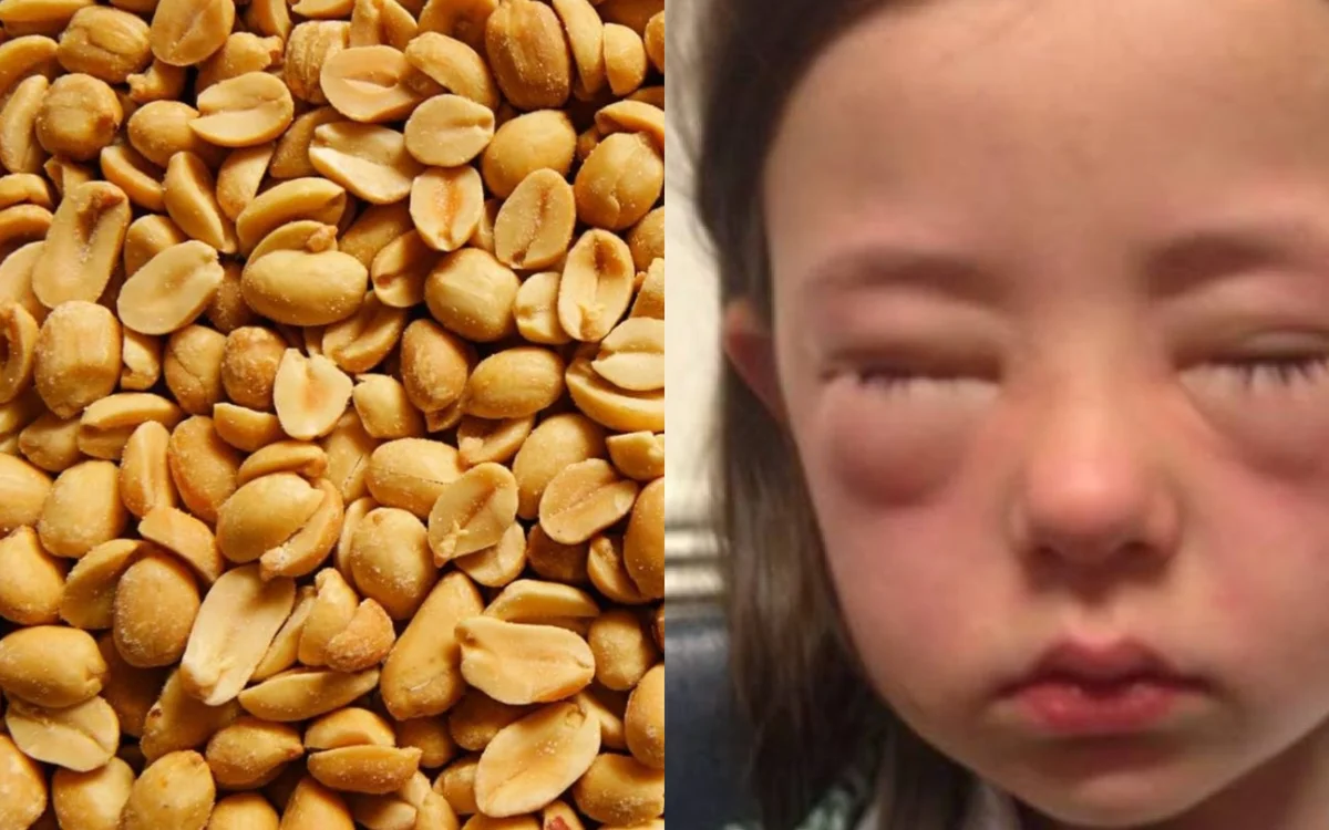 Миндаль детям. Аллергическая реакция на арахис. Аллергия на орехи у детей.