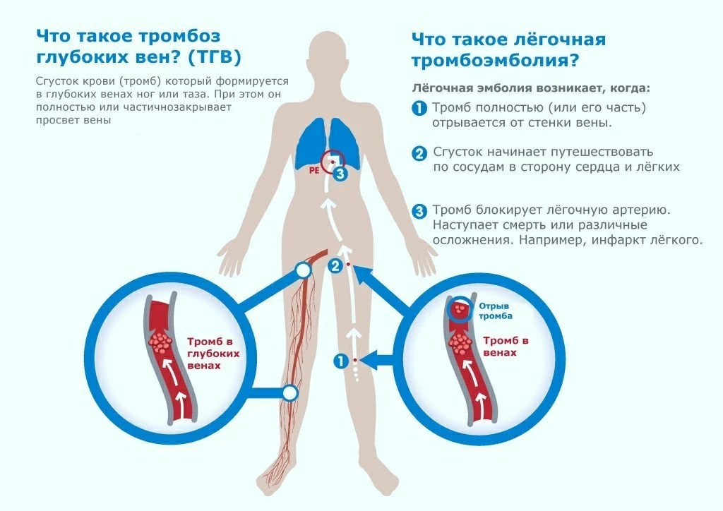 Тромбоз глубоких вен и эмболия легких. Профилактика венозных тромбозов. Тромбоз глубоких вен конечностей. Профилактика венозной тромбоэмболии.