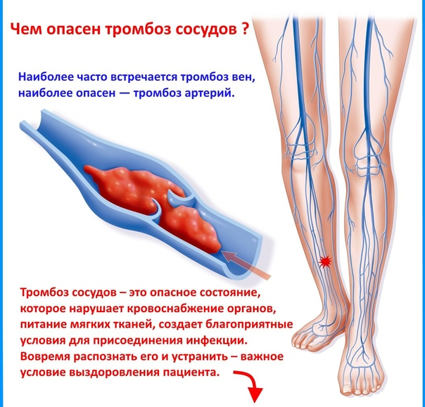 Воспаление вен на ногах: лечение, симптомы, профилактика