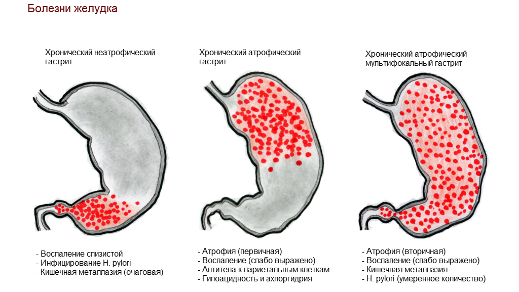 Гастрит желудка: симптомы, признаки и лечение | Клиника Рассвет