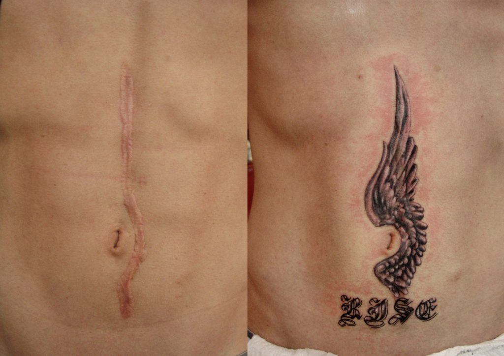 Перекрытие шрама татуировкой
