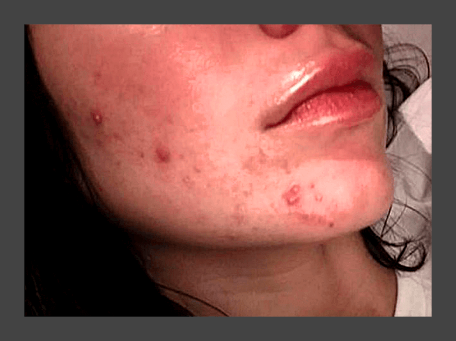 Примерно такая сыпь была у меня