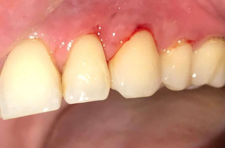 Мало кто придает значение кровоточивости и болезненности десен