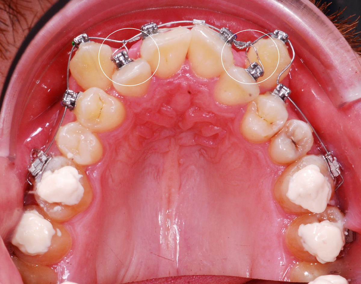Раннее подключение небно дистопированных боковых резцов
