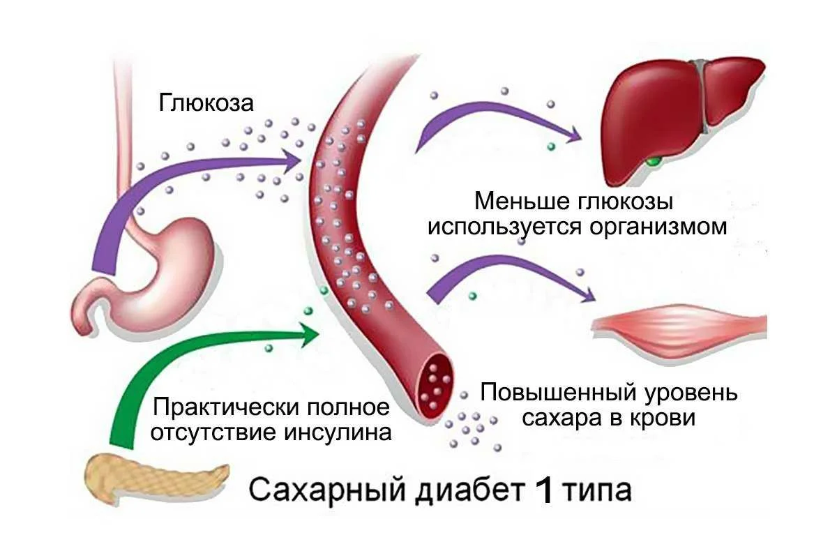 Больной сахарным диабетом 2 типа