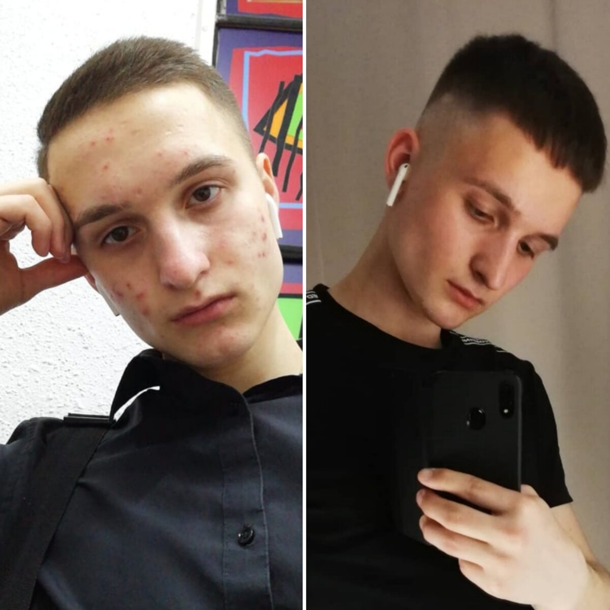 До/после. 3 месяца и ни одного прыщика 