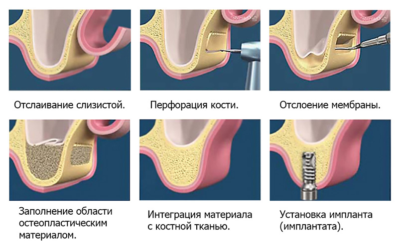 Этапы открытого синус лифтинга