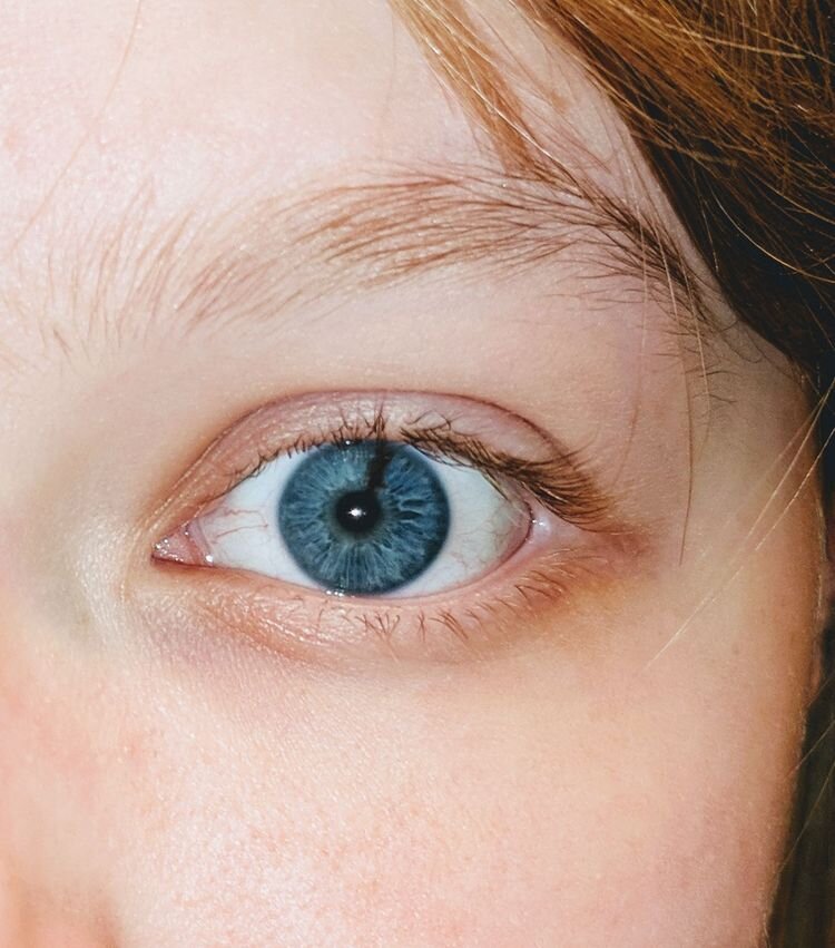 Источник: https://www.reddit.com/r/mildlyinteresting/comments/eezctc/this_stripe_i_have_on_my_left_iris
