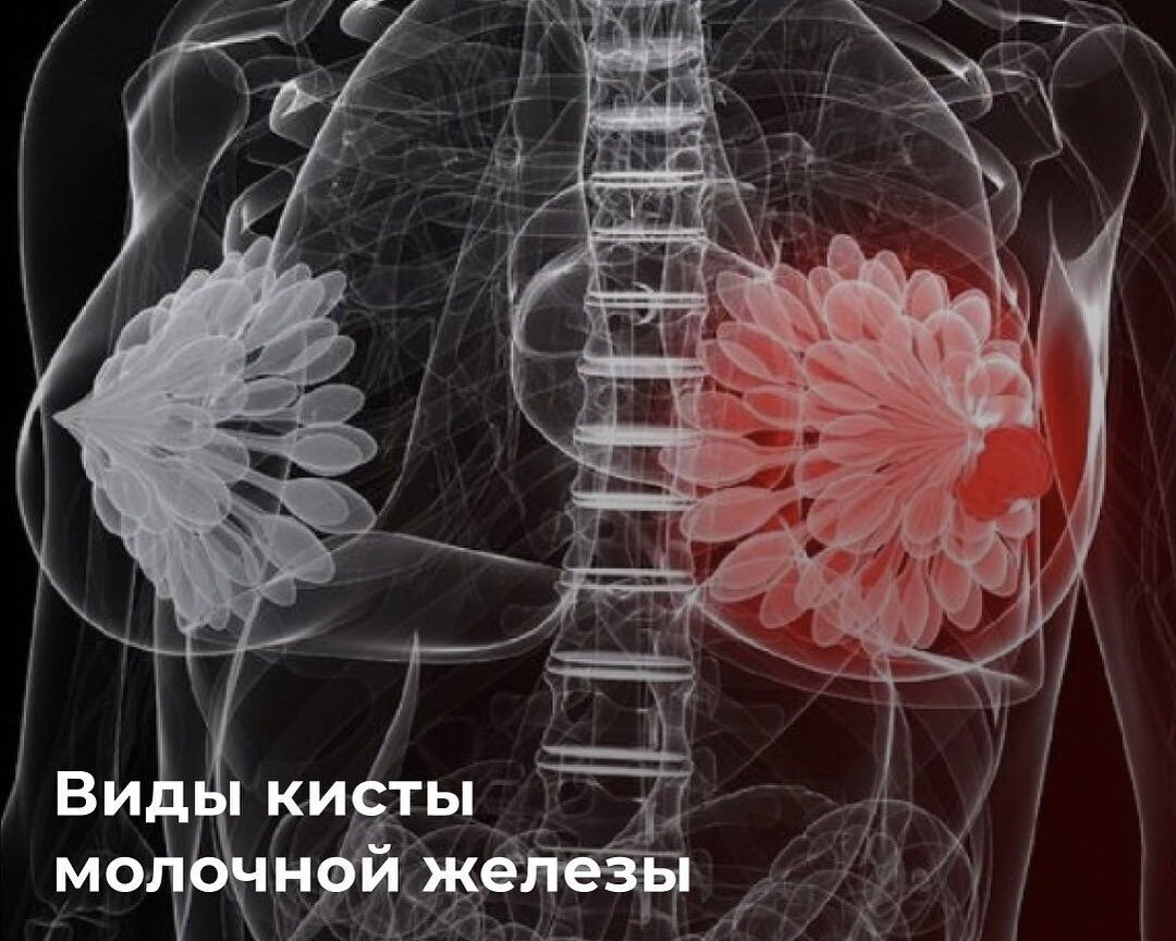 Киста молочной железы | Алексей Волченко Онколог-маммолог ...