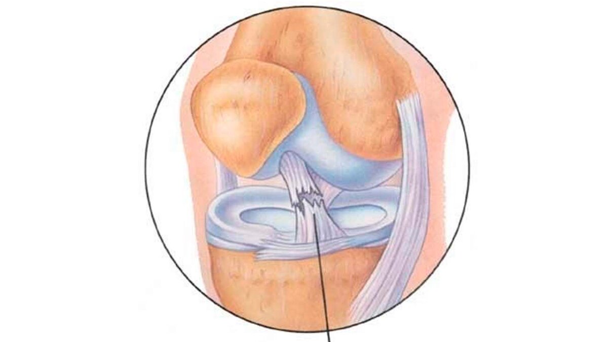 Дегенеративные изменения крестообразной связки коленного