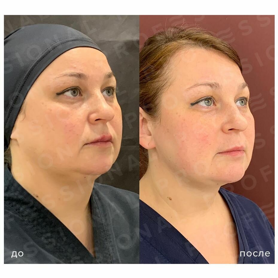 Криолиполиз,Косметология,Коррекция фигуры КИРОВ ВКонтакте