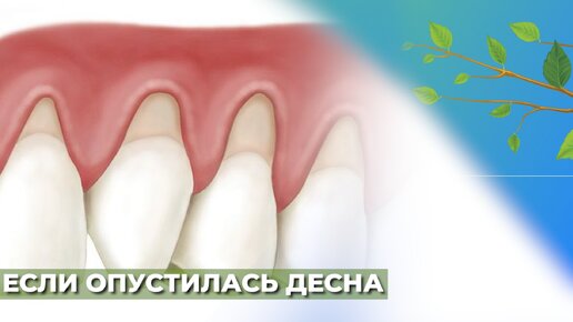 Опустилась десна. С чем связанно? Как лечить?