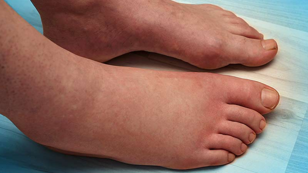 Причины опухших лодыжек, ступней и ног
