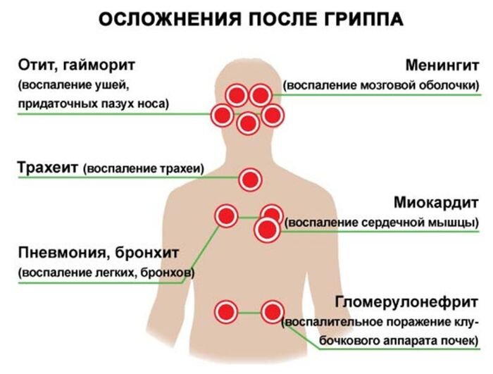 Трахеит (острый и хронический)