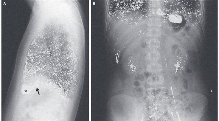     Рентгенограммы грудной клетки пациента в боковой проекции (A) и брюшной полости — в прямой (B). Стрелкой обозначено правое предсердие, астериском — правый желудочек Yunying Feng, Fengdan Wang / The New England Journal of Medicine, 2022