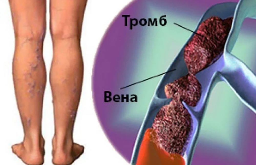 Тромбоз вен. Тромбофлебит подколенной вены. Тромб в подколенной Вене. Тромбоз глубоких вен симптомы.