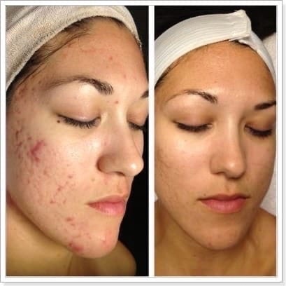 Результат после курса салицилового пилинга