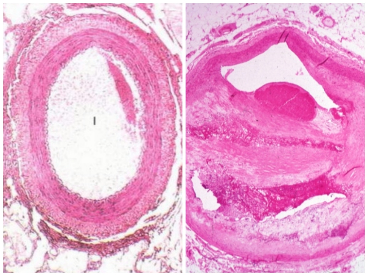 Просвет нормального сосуда/ просвет сосуда с атеросклеротической бляшкой 