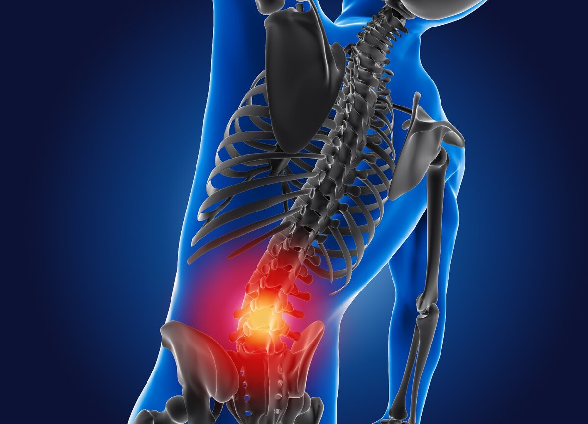 Грыжа межпозвоночного диска (грыжа позвоночника)
