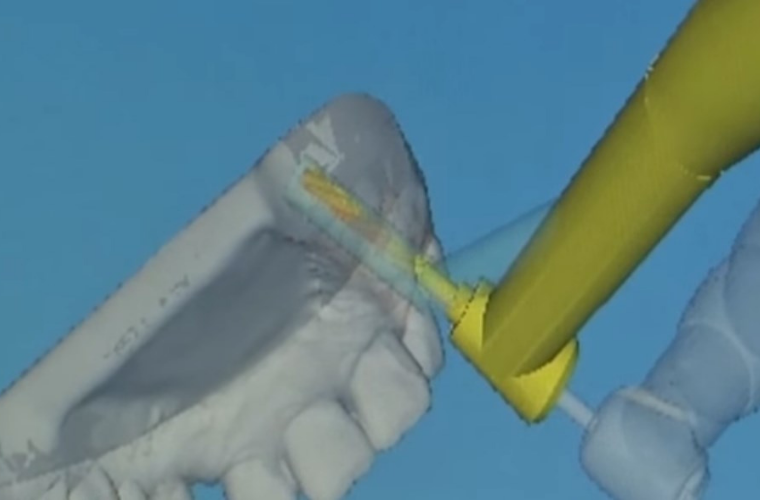 Перед совершением операции стоматологи запрограммировали оборудование и проверили движения машины на точность