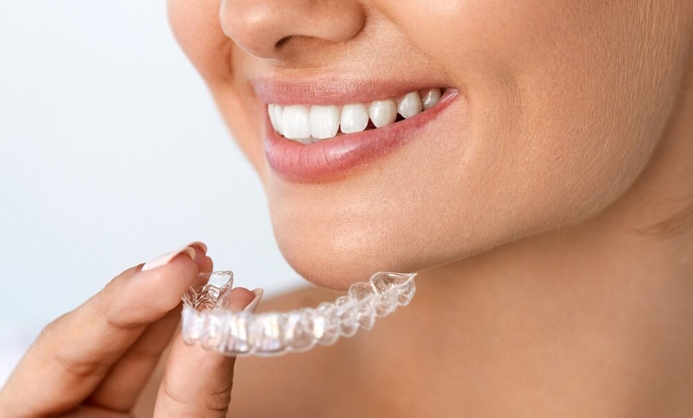 Домашнее отбеливание в каппах