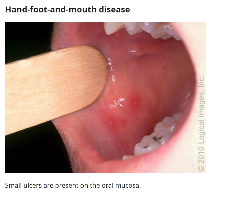 Высыпания на слизистой рта