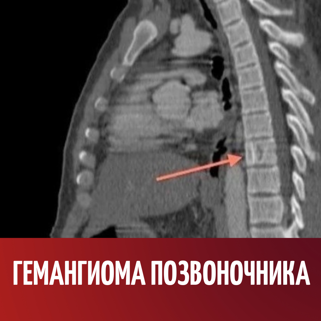 Можно ли массаж при гемангиоме. Гемангиома позвоночника. Гемангиома позвоночника грудного.