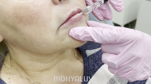 Деликатное увлажнение губ препаратом BioHyalux Fine Lines