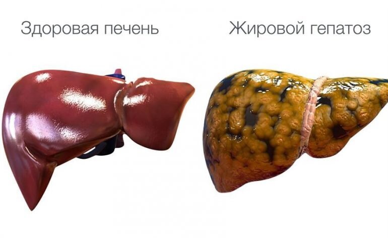 Что вы должны знать о жировом гепатозе - "жирной" печени