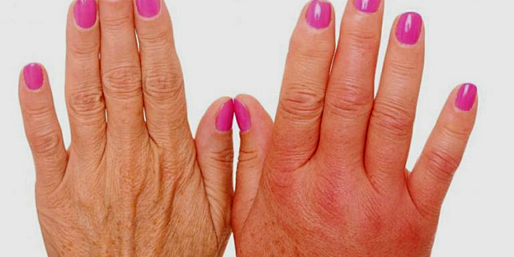 Воспалительный процесс суставов пальцев.