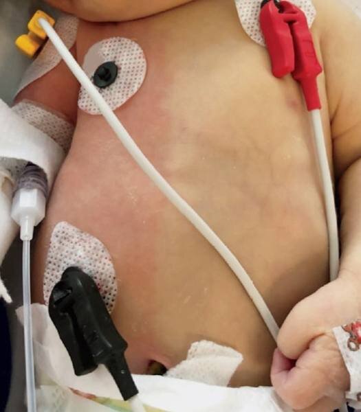 👶 На третий день жизни у этого малыша появилась одностороннее покраснение кожи с чёткой границей.📍 Данное состояние носит название синдром Арлекина и является доброкачественным явлением. Выявляется как у новорождённых после назначения простагландинов, так и у абсолютно здоровых детей. Пpичиной может являться изменение тонуса сосудов, однако достоверных данных об этиологии данного явления нет. Лeчение не требуется. В данном случае, изменение цвета кожи наблюдалось в течение нескольких минут и разрешилось самостоятельно.