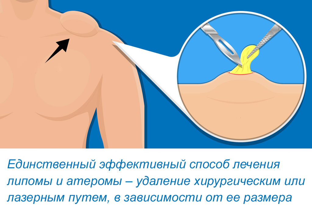 Атерома - что это и как это лечить?