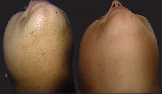 8 процедур на диодном лазере фото до и после. Фото с сайта https://www.ncbi.nlm.nih.gov/