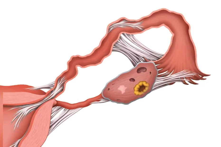 Спайки живота у женщин. Эндометриоз спаечный процесс. Эндометриоз маточных труб. Спаечный процесс в маточных трубах.