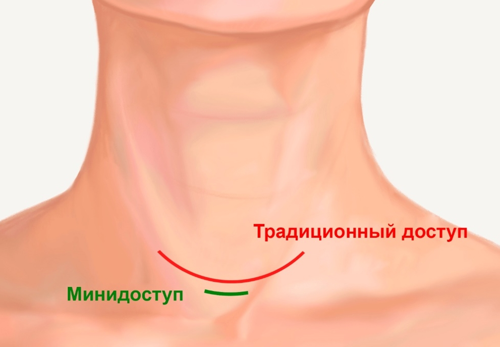 Почему нельзя сильно массировать щитовидную железу? | Клиника щитовидной железы | Дзен