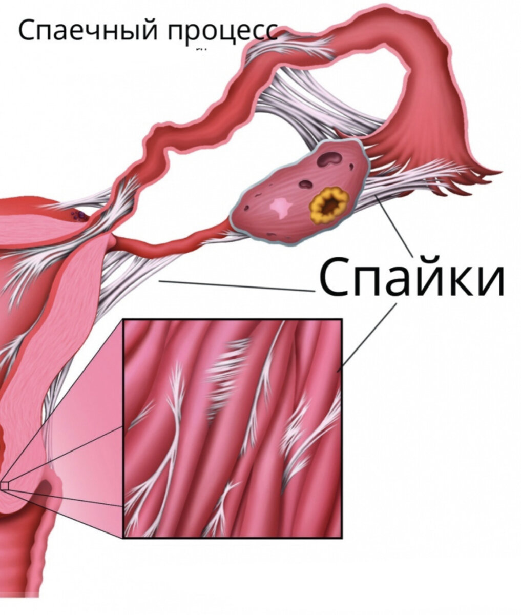 Спайк болезнь. Эндометриозные спайки. Эндометриоз маточных труб. Что такое спайка в маточной трубке.