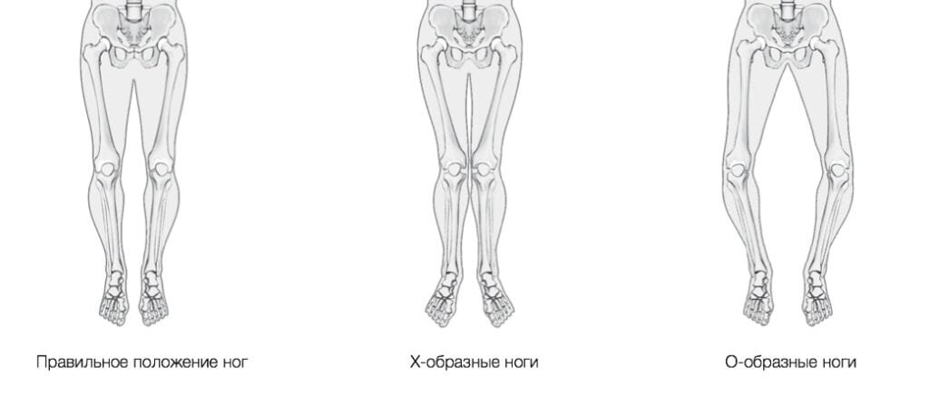 Ноги колесом. Вальгусная деформация голени рентген. Икс-образные ноги вальгус. Варусная деформация ног у взрослых.