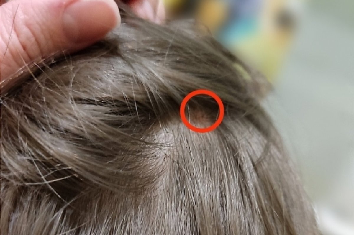    В Томске у ребенка после присасывания клеща появилась шишка