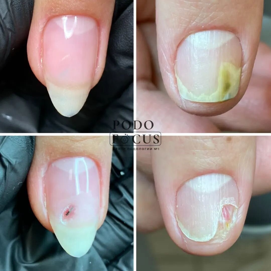 Онихолизис: как спасти отслоившиеся ногти на руках