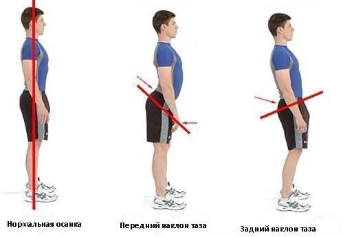 Гиперлордоз поясничного отдела лечение