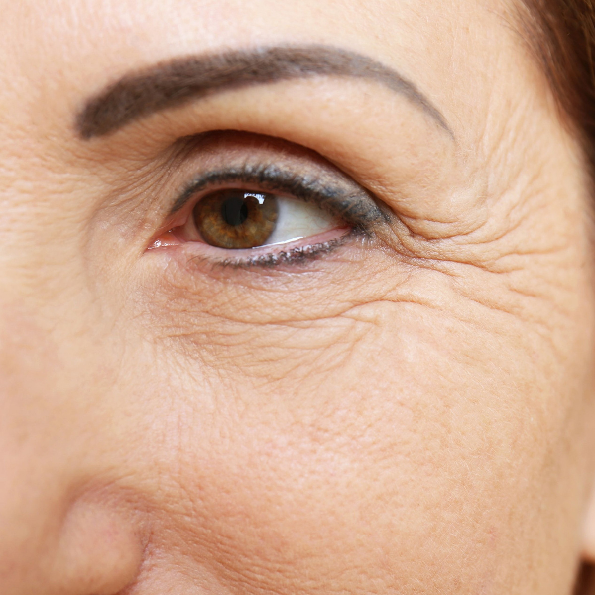 Морщины под глазами