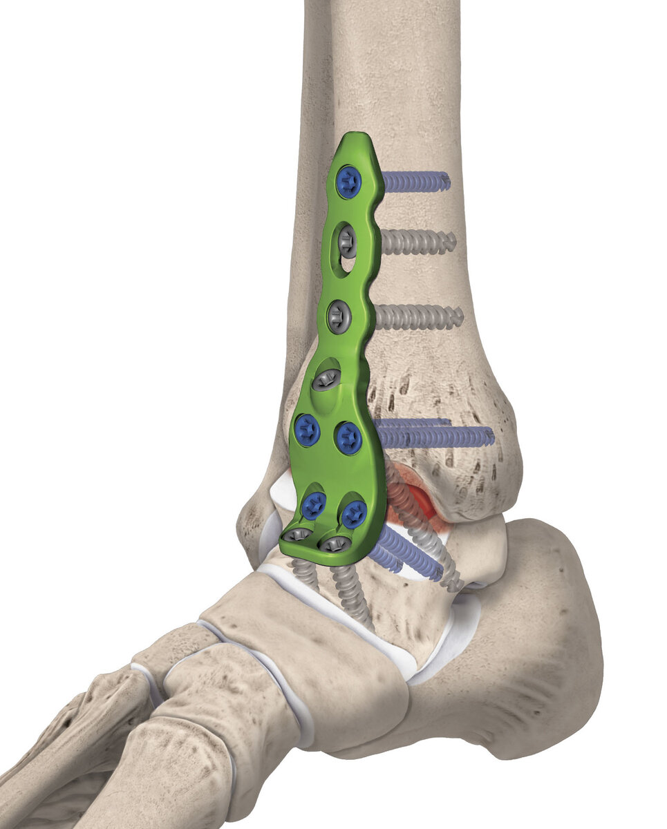 Установка пластины при переломе голени